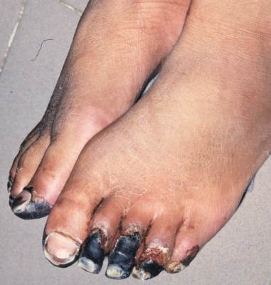 Foot1